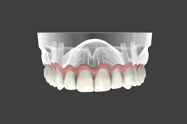 Are Implant Supported Dentures Permanent from Alameda Dental in Aurora, CO