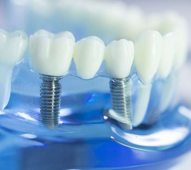 Aurora Dental Implants