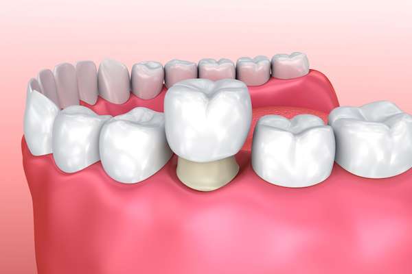 Permanent Dental Crowns vs. Temporary: Is There a Difference from Alameda Dental in Aurora, CO