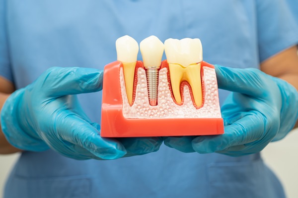 Can Multiple Teeth Need A Root Canal?