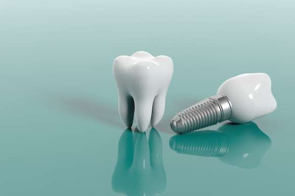 Multiple Teeth Replacement Options: One Implant for Two Teeth from Alameda Dental in Aurora, CO